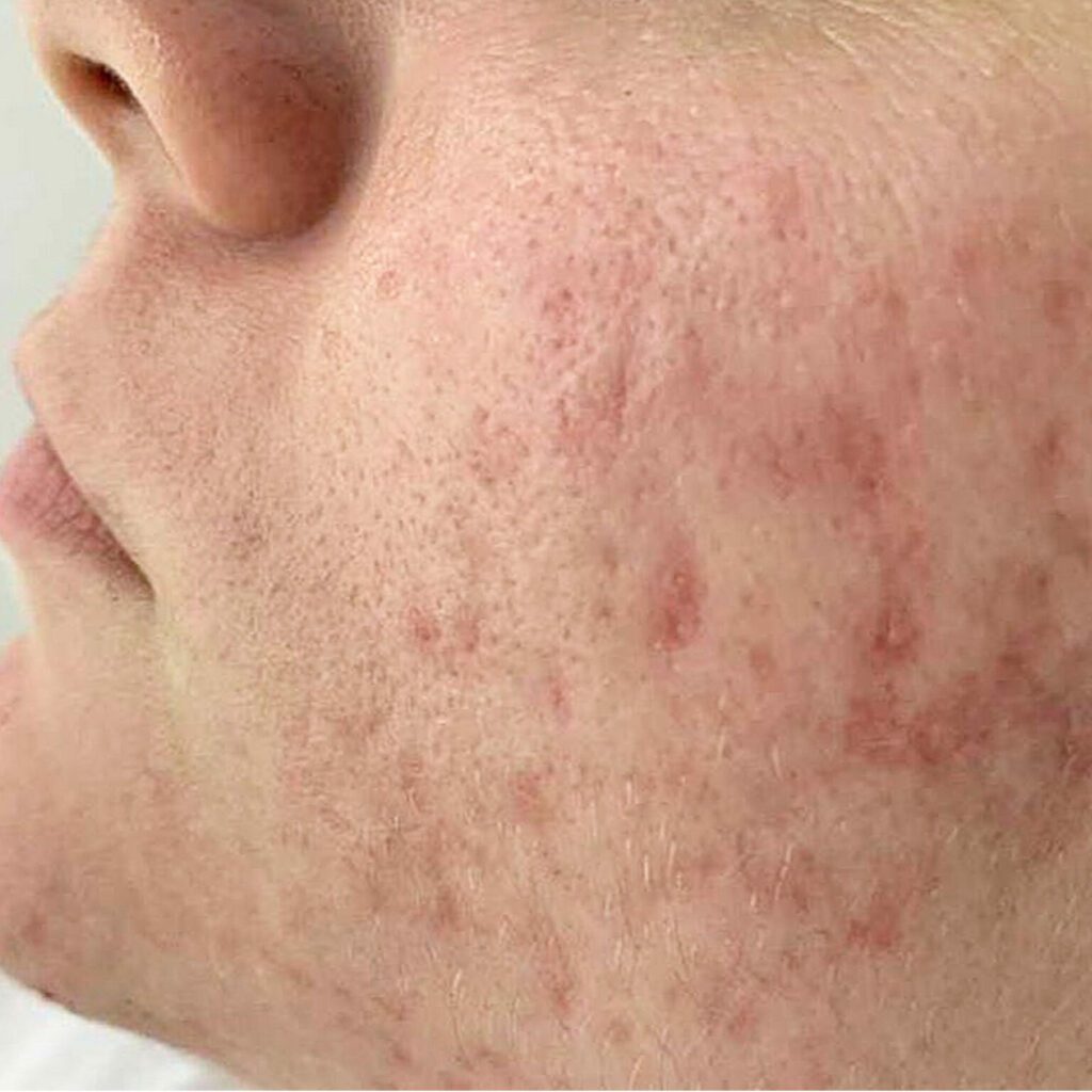 11-1536x1536 - MH derma قبل