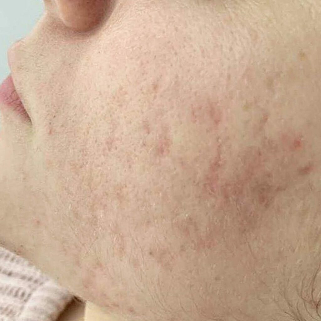 12-1536x1536 - MH derma بعد