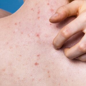 بایوریپیل موثر در رفع جوش و جای جوش بدن