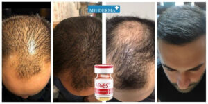 بهترین کوکتل مزوتراپی مو Ares HB