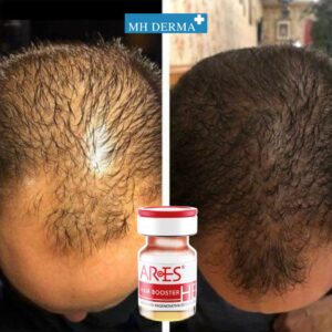 بهترین کوکتل مزوتراپی مو Ares HB