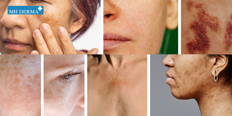 ضد لک و پیگمنتیشن ( لک های بارداری و ملاسما) - MH derma
