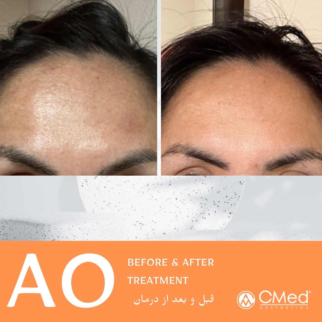 عکس قبل و بعد Ares ao انتی اکسیدان و روشن کننده پوست