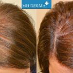 عکس قبل و بعد از مزوتراپی مو