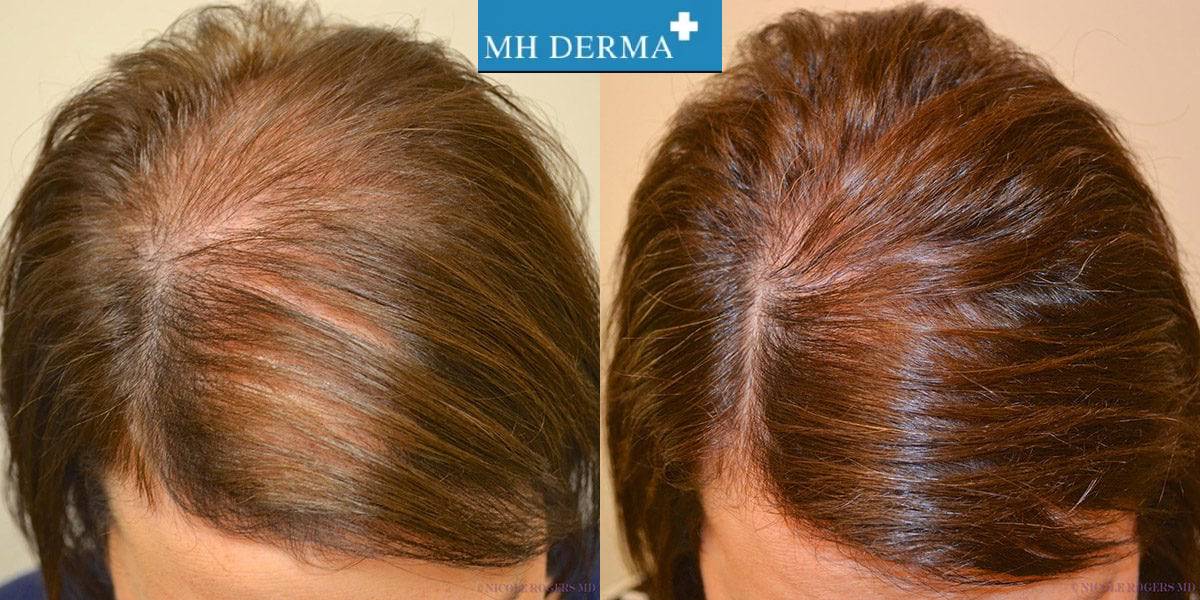 عکس قبل و بعد از مزوتراپی مو - MH derma عکس قبل و بعد از مزوتراپی مو