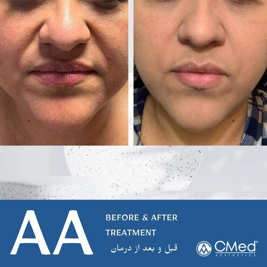 عکس قبل و بعد مزوتراپی Ares AA جوانساز