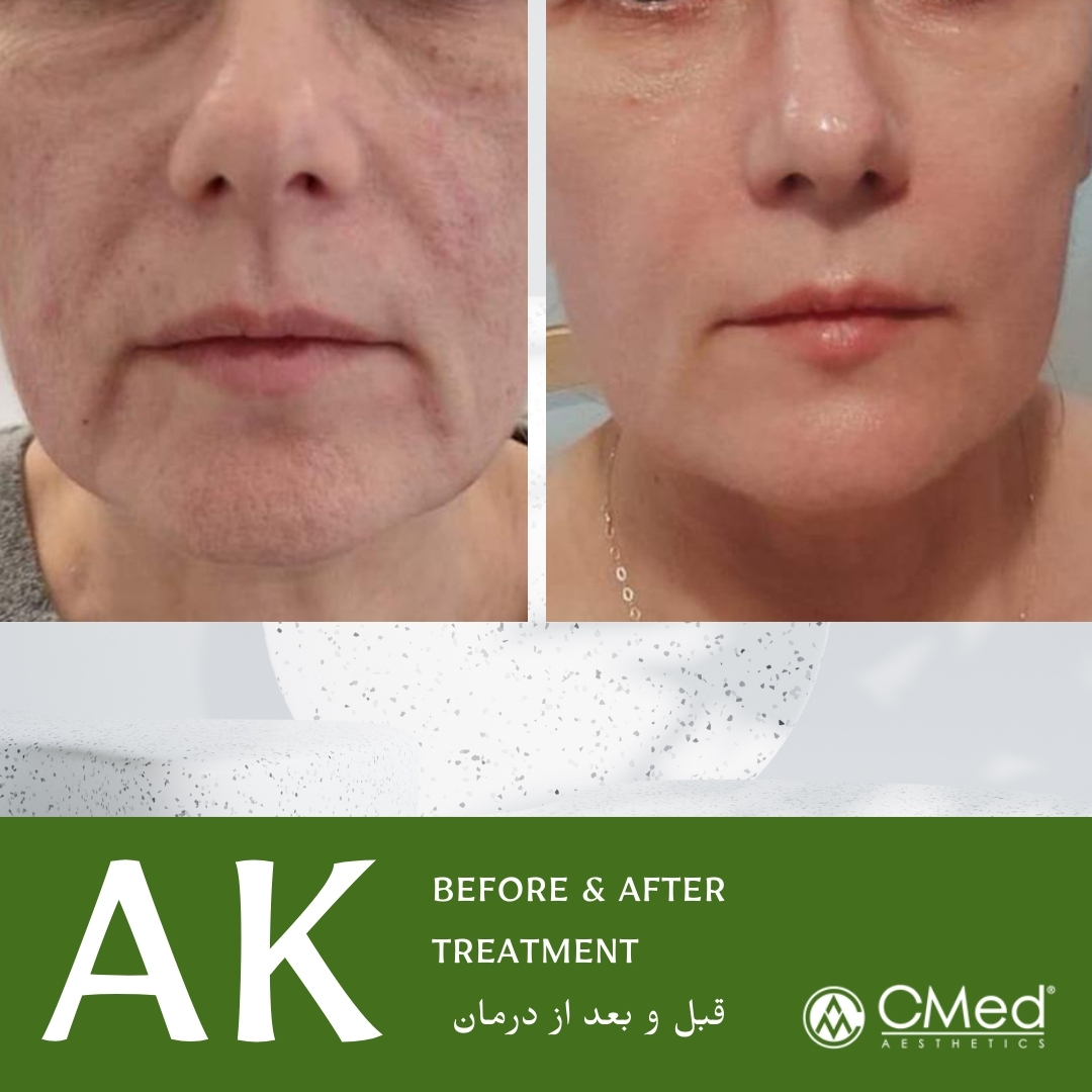 عکس قبل و بعد مزوتراپی صورت Ares k رفع خطوط و منافذ باز